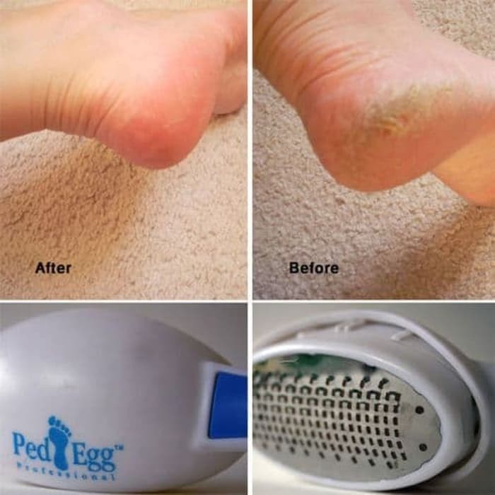 Ped Egg/Pembersih Penghalus Gosok Tumit Kaki Kapalan Kulit Mati Kering - TUMIT